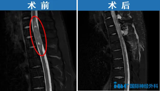 术前术后MRI对比
