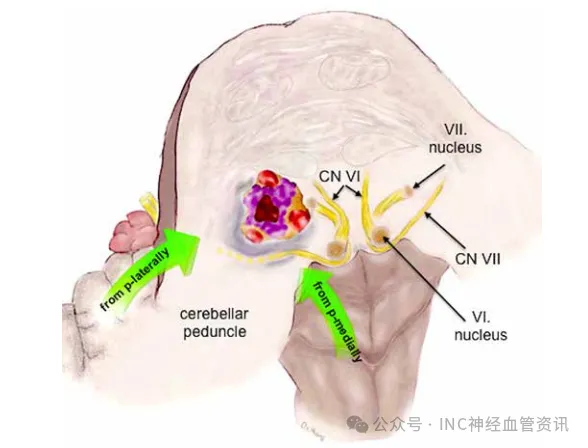 桥脑海绵状血管瘤病变位置，血管病变不邻接桥脑表面，但它单侧移动周围的固有结构，包括外展神经和面神经。