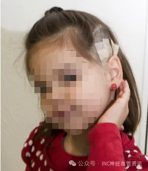 术后复查MR显示病变全切，无脑水肿、出血等情况，无任何神经功能损伤。除了头发下一个小小的伤口，几乎看不出西西刚刚经历了一场开颅手术。