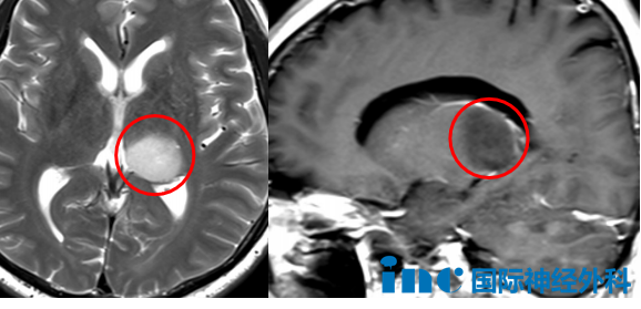 54岁左侧丘脑-海马占位