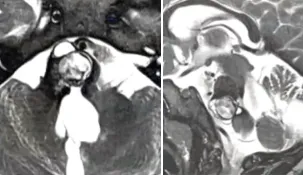 脑干海绵状血管瘤二次出血