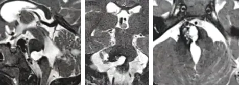 第二次手术全切