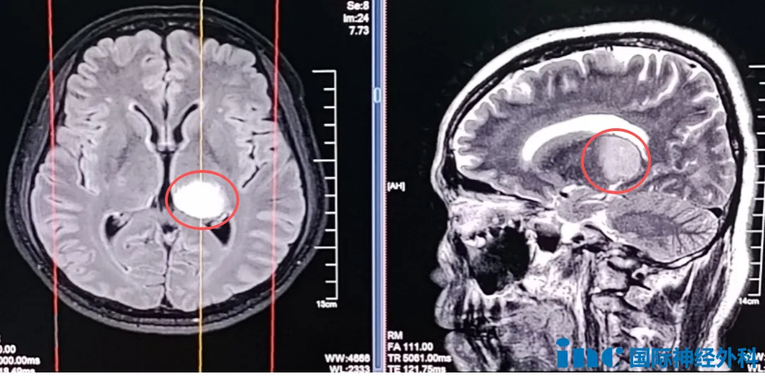 左侧丘脑-海马占位患者