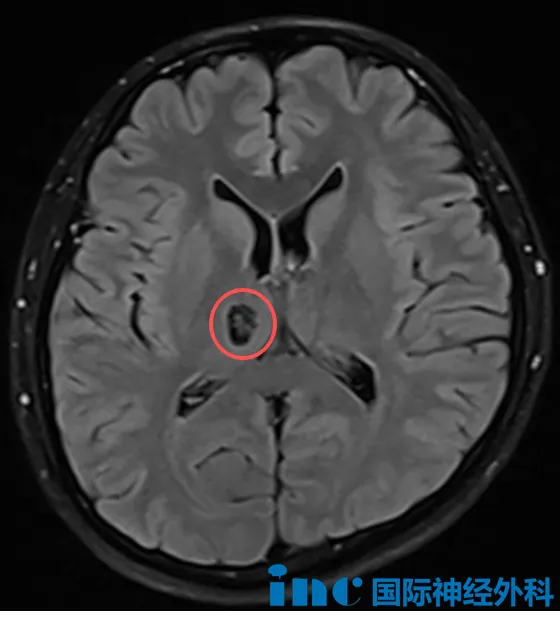 体检发现的丘脑占位