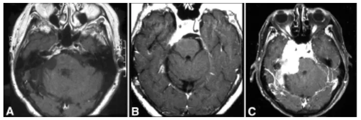 图1. 56岁女性患者，曾接受右侧蝶岩斜区脑膜瘤切除术，磁共振影像显示肿瘤进展。A：10年后随访影像显示内听道内侧及上方出现小型肿瘤复发，接受伽玛刀治疗。B：病灶稳定8年后，患者出现右侧面部感觉异常、面肌痉挛及进行性共济失调。C：2年后随访影像显示肿瘤进展。