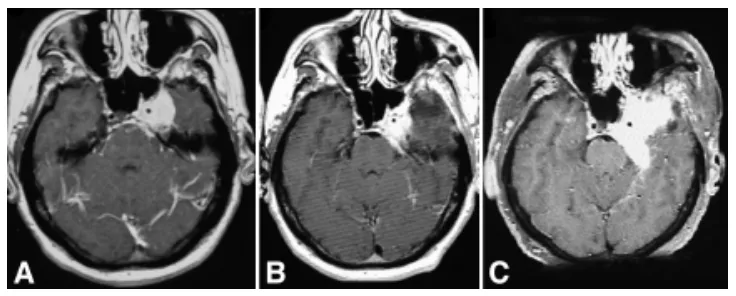 图2. 48岁男性患者，表现为眼肌麻痹伴面部感觉减退，磁共振影像显示肿瘤进展。A：左侧中颅窝占位，主要累及海绵窦。B：行次全切除术。3年后MRI显示残余肿瘤进一步生长，遂行放射外科治疗。C：放射外科治疗4年后肿瘤显著生长，行再次切除术。