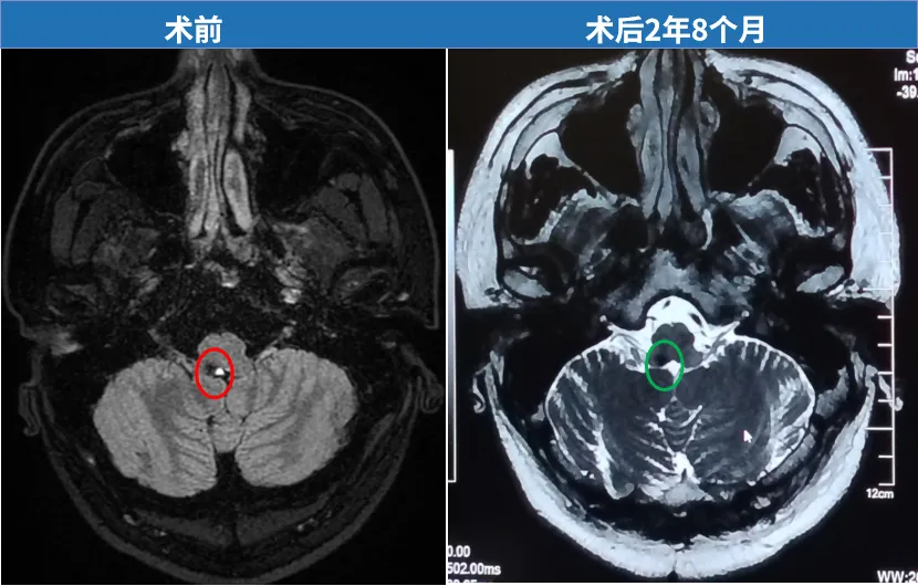 老患者随访：脑干术后近3年，“不能更好！”