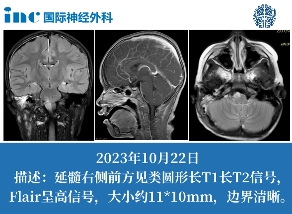 残余一半的胶质瘤，化疗能控制它生长吗？如果复发了怎么办？