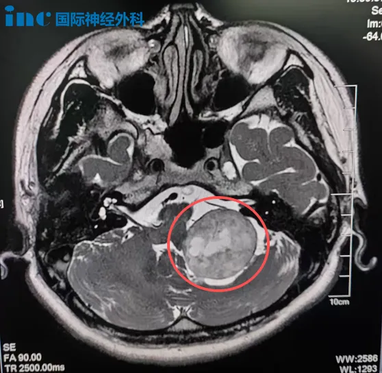 示范手术：桥小脑角区占位
