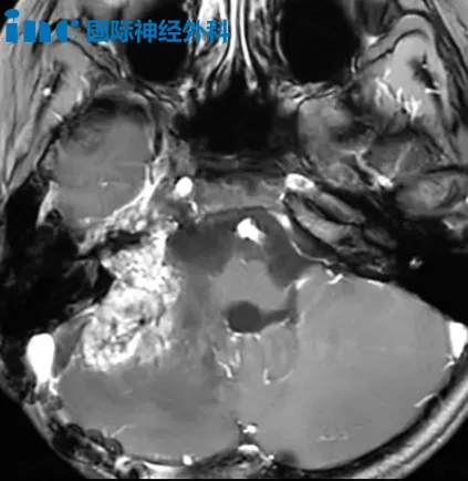 右侧桥小脑角区间变性室管膜瘤（WHO 3级）