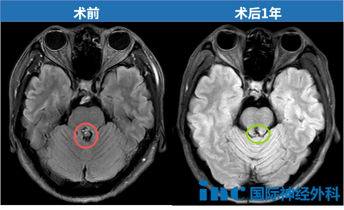 老患者随访：为何是一场“虚惊”？