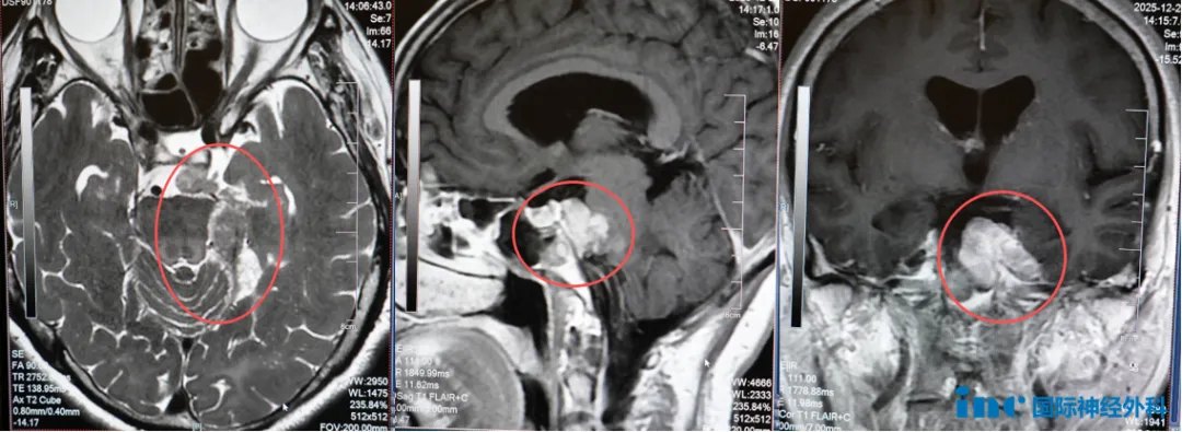 新患者咨询：一次开颅、2次放疗
