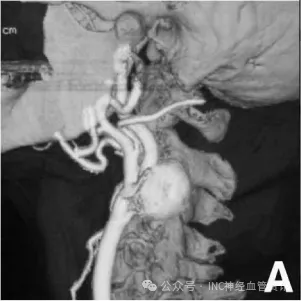 囊状动脉瘤与梭形动脉瘤图示