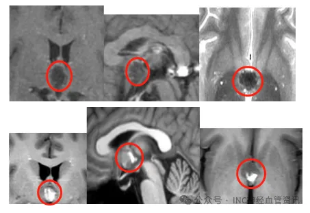 26岁青年高原返程后头痛两月未愈，一查竟是第三脑室“潜伏”的海绵状血管瘤