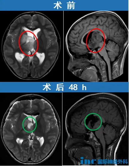 我非常高兴看到这名男孩在视频中表现出的极佳临床状态，同时手术切口愈合良好。