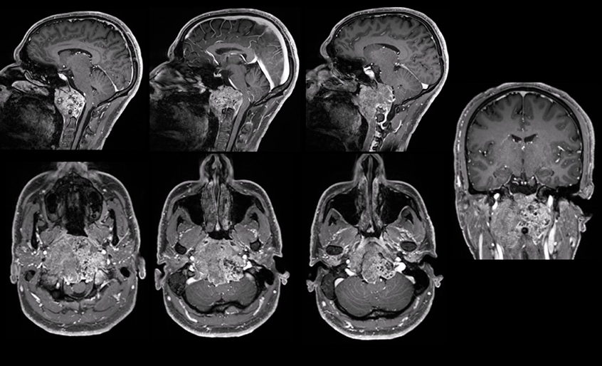 26岁男性巨大脊索瘤