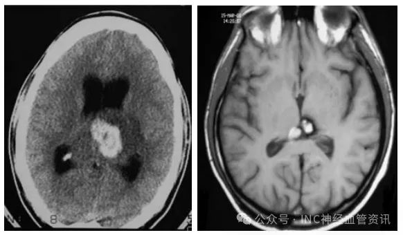 图1，左：头颅CT扫描显示最初的病变诊断为丘脑肿瘤。右：40 gy分割放疗一年后，根据磁共振成像，左丘脑病变被重新考虑为丘脑海绵状血管瘤。与未辐照的对照CH组织样本相比，治疗后病变间质存在内皮细胞破坏和明显纤维化。