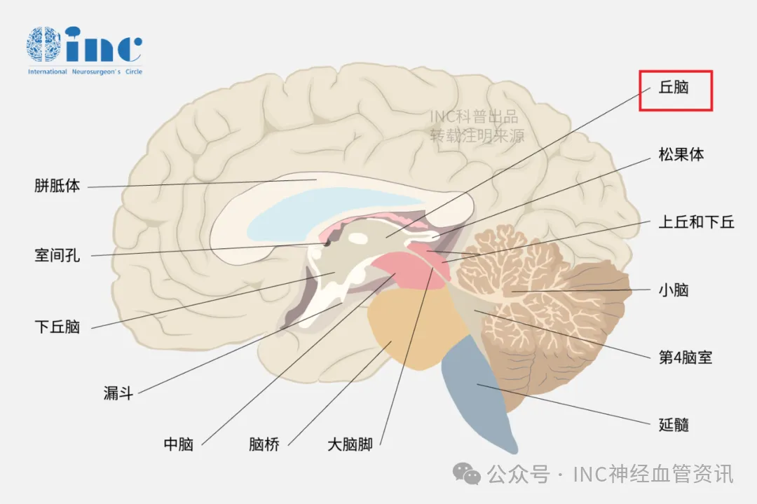 正因其功能关键、结构复杂，且周围布满重要的神经核团与血管，此区域的手术向来被视为“雷区”，稍有不慎就可能导致偏瘫、感觉障碍等严重后遗症。
