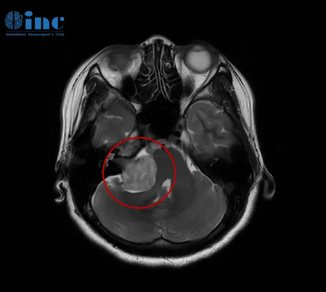 右侧CPA区前庭神经鞘瘤