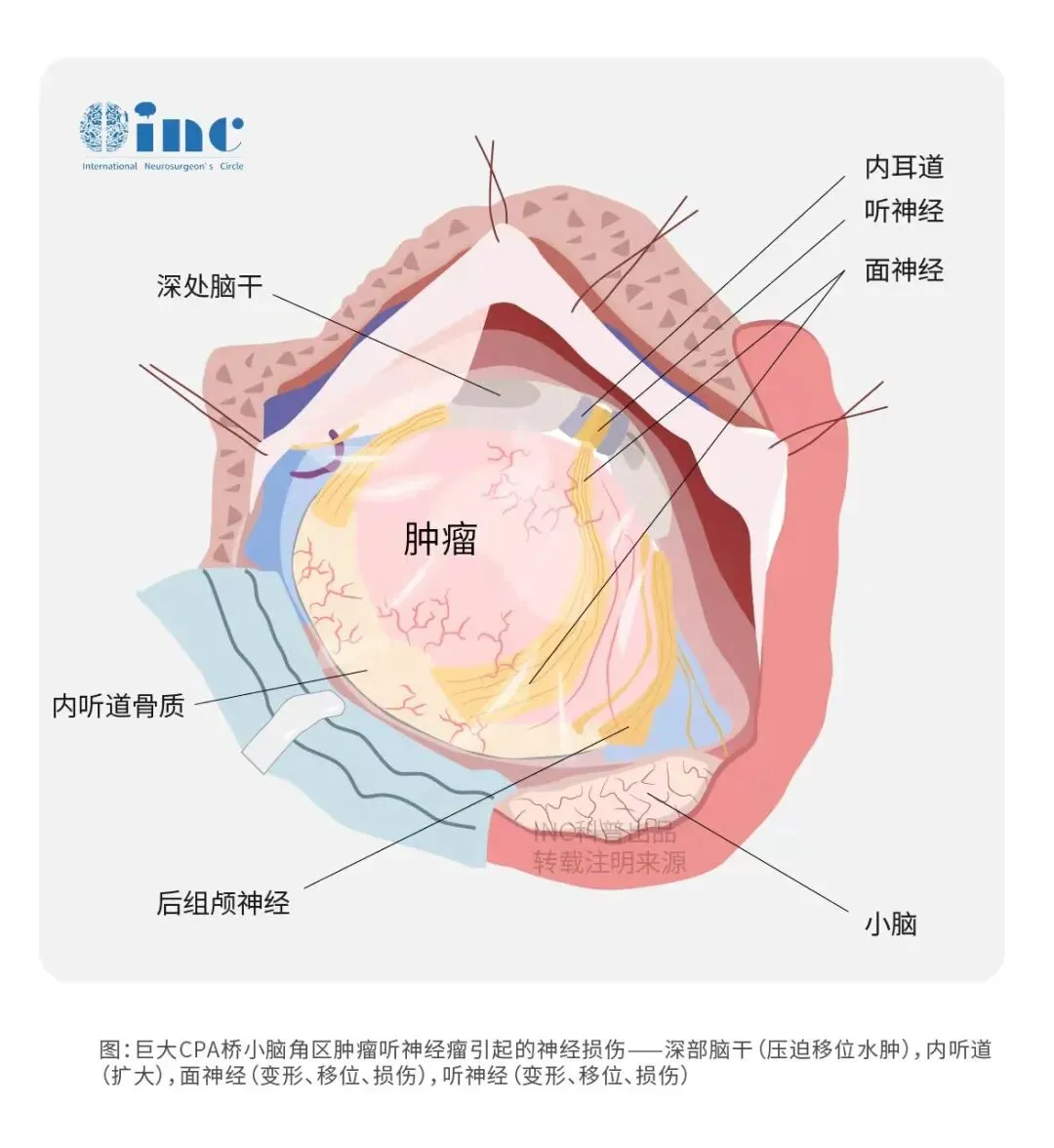 由于肿瘤较大，放化疗已无法消除肿瘤，手术切除是唯一选择。