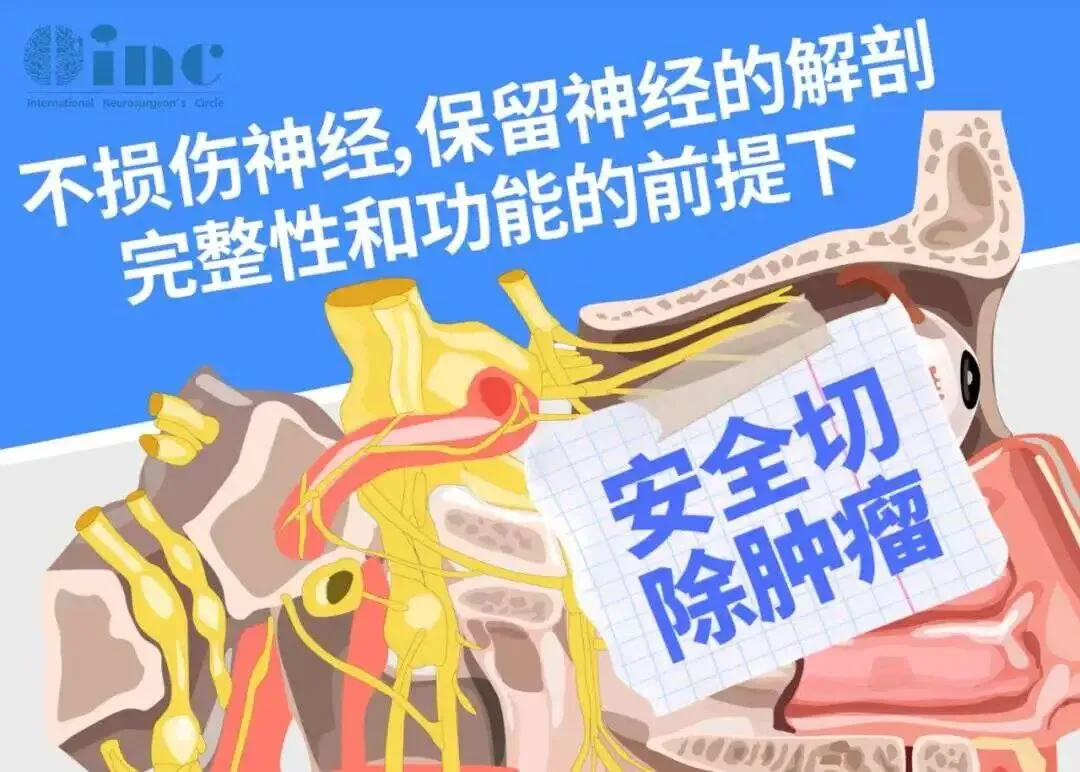 成功的手术不仅要把肿瘤切除干净，防止复发，还要尽可能保留听神经和面神经功能，这对主刀医生的技术、医疗团队的配合和医院设备都提出了极高要求。