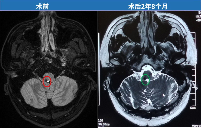 肿瘤完全切除，无残留，无复发，更没有出现任何新的神经功能损伤