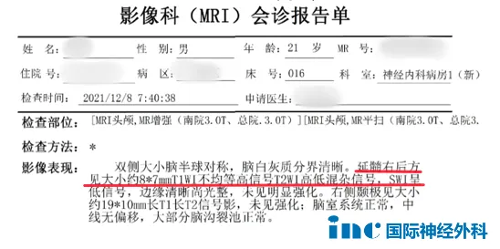 疑似延髓海绵状血管瘤，良性病变，但位置很特殊。