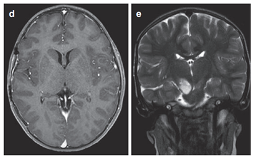 六个月后的影像显示丘脑部分切除和中脑的小肿瘤残留，因此，Rutka教授根据其病情发展量身定制辅助治疗计划，患儿对放疗反应良好。
