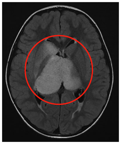 Rutka教授为其先行左额部内窥镜活检和鼻中隔造瘘术，再行左枕脑室-腹腔分流术。