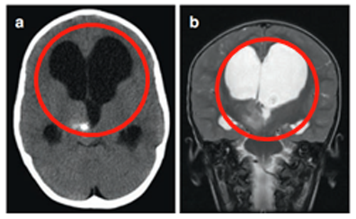 3岁患儿-丘脑病变伴钙化