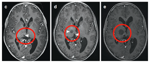 在8岁、11岁和13岁时，James T. Rutka教授成功地利用第三脑室内窥镜切开术治疗脑积水