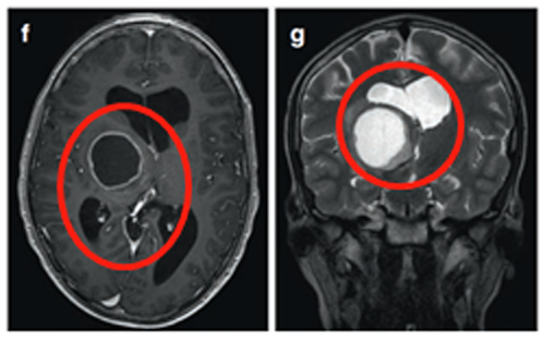 肿瘤囊肿持续扩大(图3)，患儿发展为急性偏瘫。