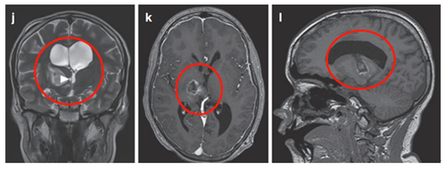 术后患儿偏瘫改善，患儿生长和智力发育正常，近期随访显示脑瘤未复发。