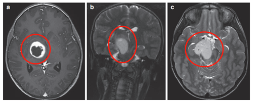 轴位MRI造影剂及冠状面T2-WI显示一个环形增强的右侧丘脑结节肿瘤。