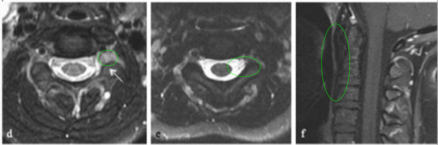 术后MR显示肿瘤切除达95%以上，C2-C3神经孔内有小残留肿瘤（d，如箭头所示）