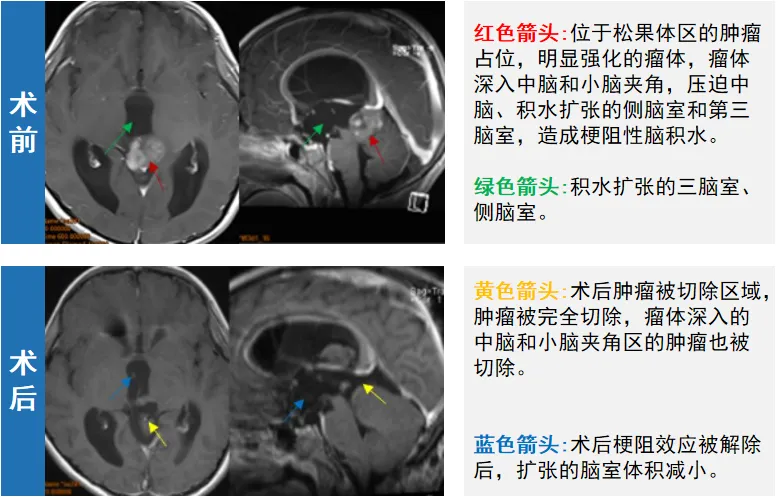 术后第一天，真真依然保持清醒状态，在术后ICU观察两天之后情况良好，无明显并发症并且顺利出院。