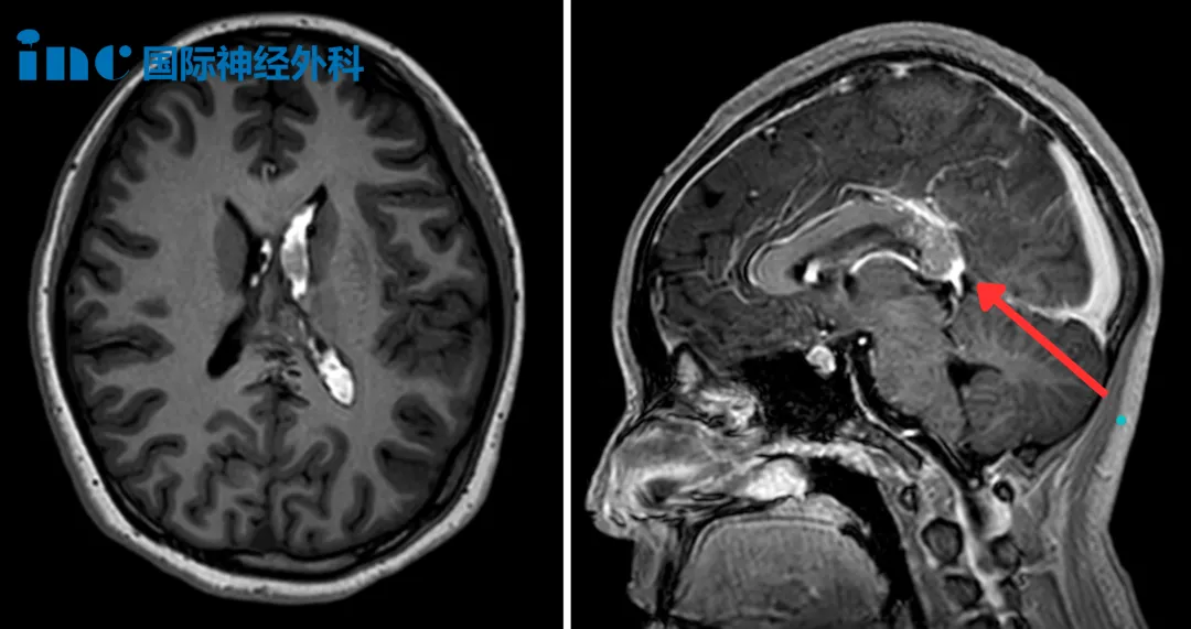 胼胝体压部存在一个22mm×15mm的橄榄形动静脉畸形（AVM）