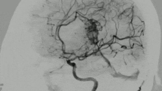 高难度的胼胝体压部弥散型动静脉畸形（AVM）