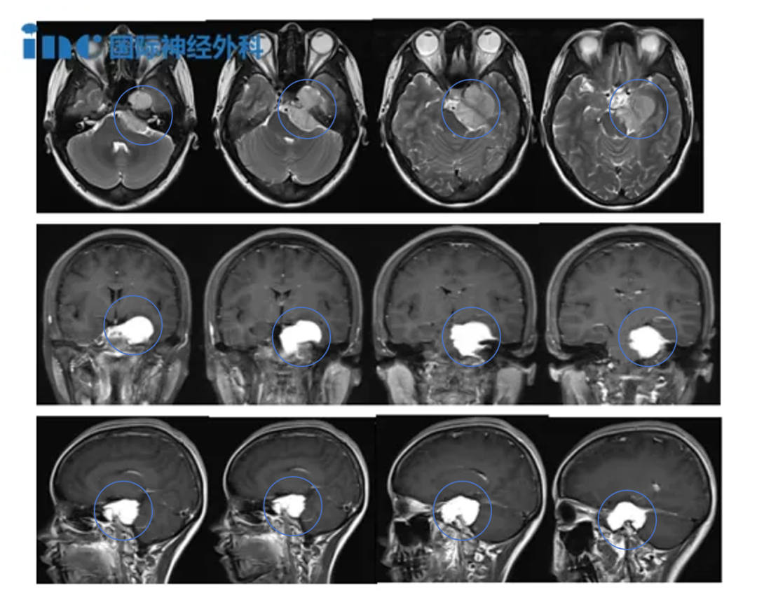 体检发现的4cm脑膜瘤