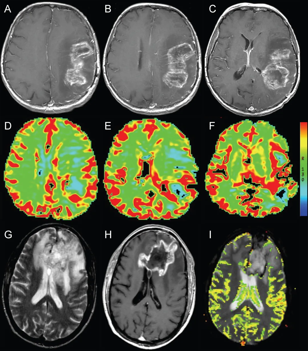 图2. 动态磁敏感对比灌注成像辅助鉴别假性进展。A-C：左侧额顶叶胶质母细胞瘤放疗后即刻轴位T1加权增强MRI，显示环形强化坏死性占位伴周围水肿及占位效应（与图1为同一患者）。D-F：轴位动态磁敏感对比灌注图像显示强化病灶后缘血容量轻度增加（箭头所示）。G：轴位T2加权MRI显示放疗后左侧额叶环形强化坏死性占位周围显著水肿，疑似肿瘤复发。H：轴位T1加权增强MRI显示结节状环形强化占位伴坏死。I：轴位动态磁敏感对比灌注图像未见血容量升高，符合假性进展病理诊断