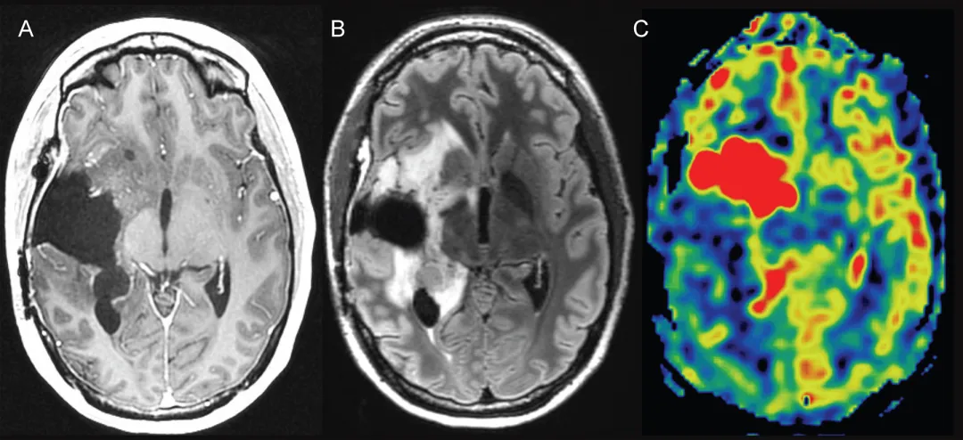 图3. 动脉自旋标记灌注成像辅助鉴别真性进展。右侧岛叶胶质母细胞瘤放疗后1年—A：轴位T1加权增强MRI显示右侧基底节区切除腔前缘斑点状微弱强化。B：轴位FLAIR图像显示切除腔周围非特异性高信号异常。C：轴位动脉自旋标记灌注图像显示血流量显著增加，针对此区域的再次切除术证实广泛肿瘤复发。