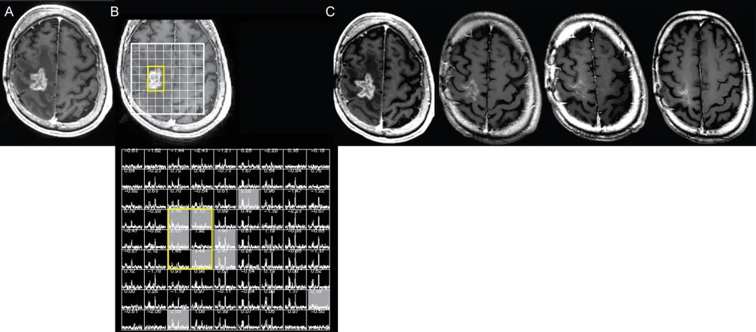 磁共振波谱成像（MRS）作为体素内代谢物标记的无创手段，也可辅助诊断真性进展