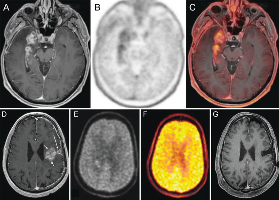 图5. PET在复发判断中的应用案例  A-C：右颞叶GBM放疗后6个月  A：轴位T1增强MRI显示右内侧颞叶占位性强化。B：轴位FDOPA PET显示右颞区代谢摄取增高。C：轴位FDOPA PET-MR融合图像精确显示代谢活性定位于右内侧颞叶占位  D-G：左额叶复发性GBM再程放疗联合免疫治疗后2个月  D：轴位T1增强MRI显示手术切缘深部（长箭头）类肿块强化灶（短箭头），基于此影像行再次切除。E：轴位FDOPA图像显示强化灶内无摄取增高。F：轴位FDOPA伪彩图显示强化灶内无摄取增高。G：再次切除术后1月轴位T1增强MRI显示无残留强化