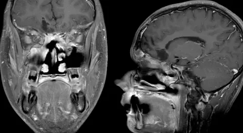 位于鼻腔和颅内的肿瘤已经大体全切了，后续的治疗方案，我们还会进一步与家属沟通。