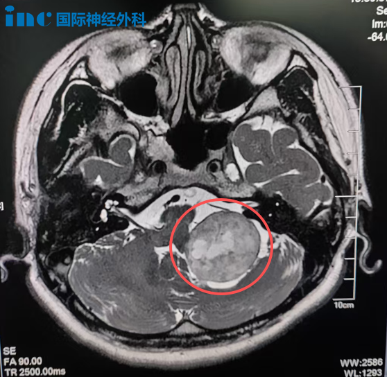 由于位置深在、毗邻重要神经与血管，手术被普遍评估为高风险。无奈，林女士选择了射波刀放疗