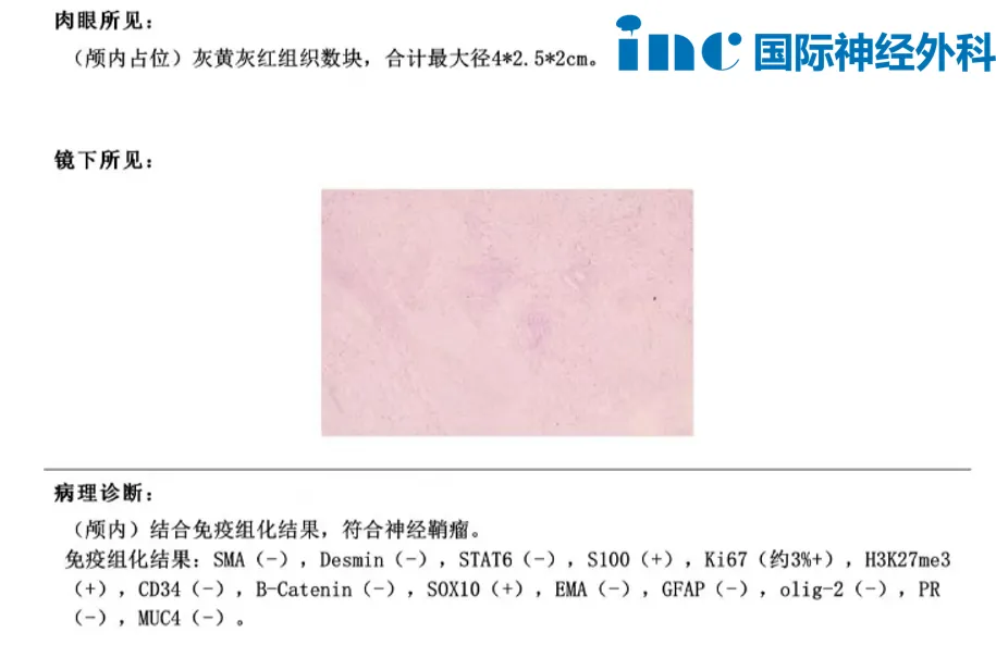 巴教授主刀的高难度手术，在苏州大学附属第四医院顺利完成，肿瘤得到满意切除。