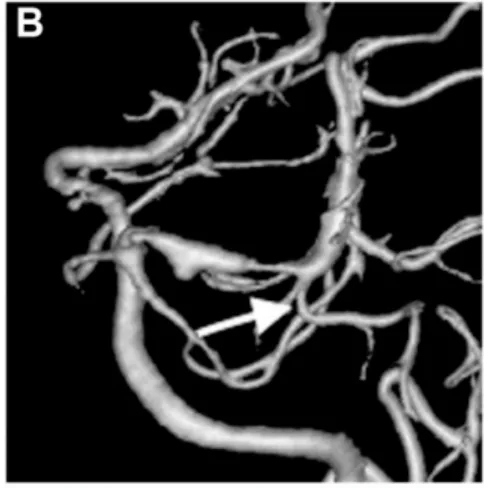 出血后 18 天血管造影显示左侧 P1-P2 段扩张伴狭窄特征，颞后动脉自狭窄病变远端发出（箭头标注）
