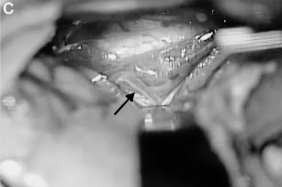 C、D. 选择颞后动脉（箭头标注）作为受体动脉，经左侧颞下入路用连续缝合行颞浅动脉 - 颞后动脉吻合；