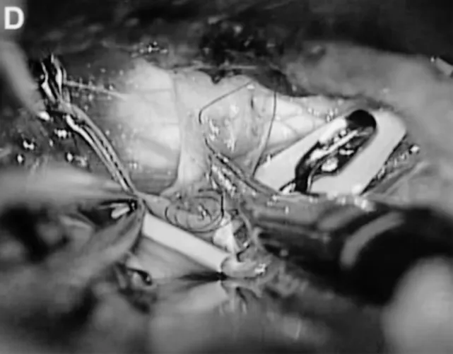 医生通过左侧颞下入路，选择后颞动脉作为受体