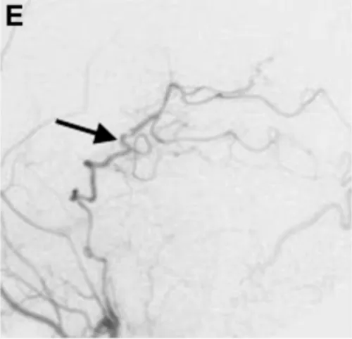 术后1周颈外动脉血管造影显示，通过分流血管，整个左侧大脑后动脉供血区血流良好（箭头标注）